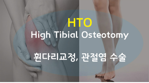 HTO 간단설명 이미지