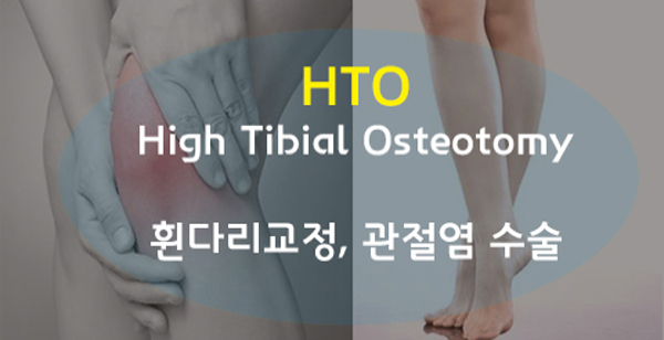 HTO ܼ ̹
