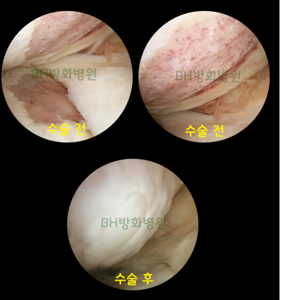 무릎 내부 관절경 사진