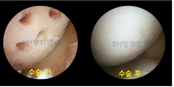 무혈성괴사 관절경 사진