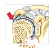 석회화건염 사진