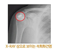 X-RAY 상으로 보이는 석회화건염 사진