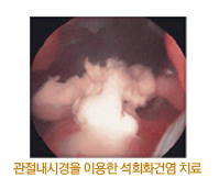 관절내시경을 이용한 석회화건염 치료