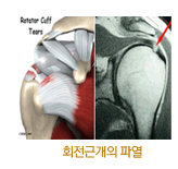 회전근개파열 사진