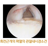 회전근개의 파열의 관절내시경소견 사진