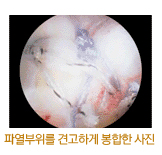 파열부위를 견고하게 봉합한 사진