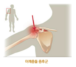 어깨충돌증후군 환자의 사진