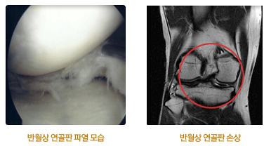 반월상 연골판 파열 및 손상 사진