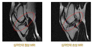 십자인대 정상 및 손상 비교 사진