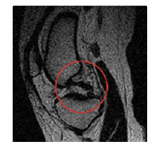 후방 십자인대 MRI 사진