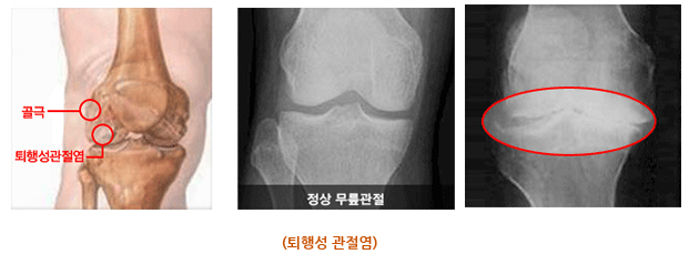 퇴행성 관절염 사진