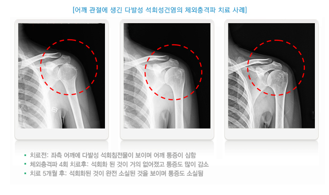 어깨 관절에 생긴 다발성 석회성건염의 체외충격파 치료 사례-치료전 : 좌측 어깨에 다발성 석회침전물이 보이며 어깨 통증이 심함, 체외충격파 4회 치료후 : 석회화된 것이 거의 없어졌고 통증도 많이 감소, 치료 5개월 후 : 석회화된 것이 완전 소실된 것을 보이며 통증도 소실됨