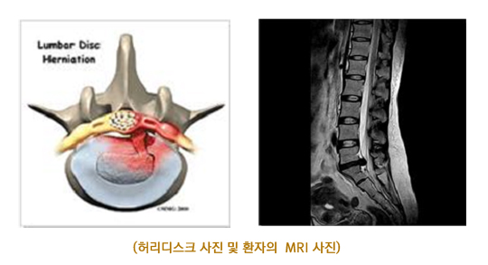 허리디스크 이미지 및 환자의 MRI 사진