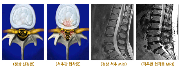 정상 신경관과 협착증 환자의 비교 사진